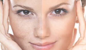 Trị nám, tàn nhang