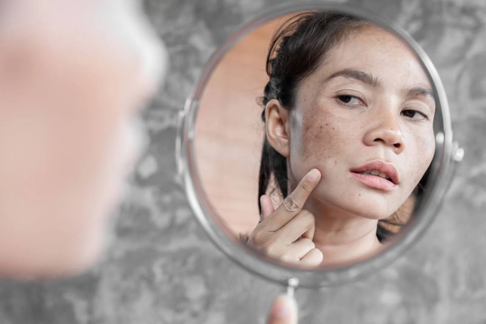 Bị tàn nhang có trị được không? Bị tàn nhang có trị được không?