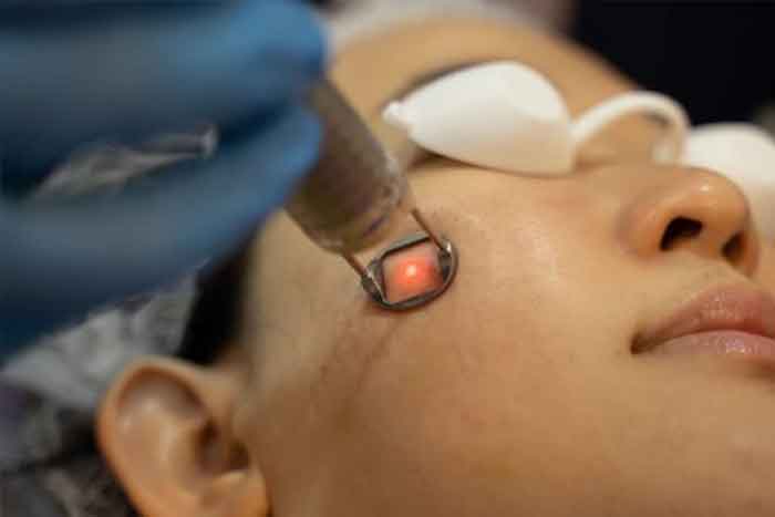 Bật mí 2 phương pháp trị tàn nhang tận gốc 3 ban tia laser tri tan nhang