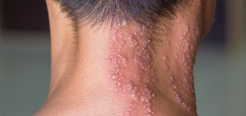 cach_boi_acyclovir_sau_phun_moi_b0bc3a61a0 Sản phẩm sử dụng cho người bị Herpes Zoster