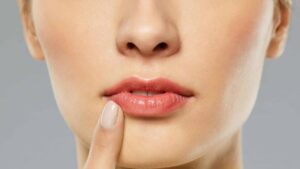 Phun môi bị nứt