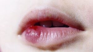 Cơ địa sẹo lồi có xăm môi được không?