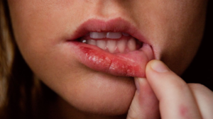 Phun môi bị mụn nước có sao không? 3 Có nên bóc vảy môi phun không? 3