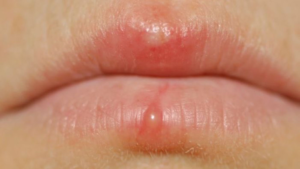 Xăm môi bị mụn nước