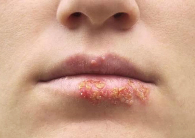 Góc giải đáp xăm môi bị chảy nước vàng có sao không và cách xử trí đúng2