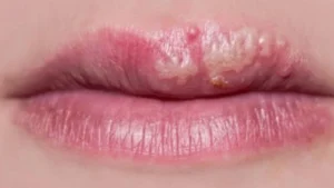 xăm môi bị chảy nước vàng