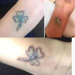 xóa xăm bị nổi mụn nước