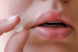 Mụn nước ở môi sau khi phun xăm có nguy hiểm không? Nên uống thuốc gì? 1 images 1 1