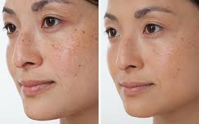 Tàn nhang có bị lan ra không? Để lâu có sao không? 2 images 5