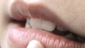 Khử thâm môi không phun màu