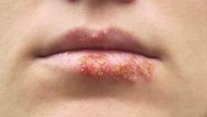 xăm môi bị lên mụn nước