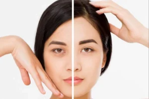 Nâng Cung Chân Mày: Giải Mã 3 Cách Phẫu Thuật Được Ưa Chuộng