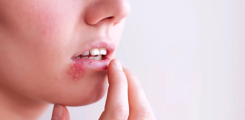 Xăm môi bị lở loét là dấu hiệu nhiễm trùng Xăm môi bị lở loét là dấu hiệu nhiễm trùng