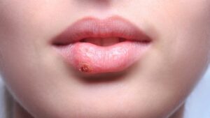 nhan biet som dau hieu cua phun moi bi nhiem trung yr iek 1669805404 2685cbff11