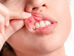 Nổi mụn nước trong miệng