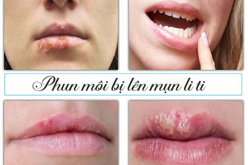 Các dấu hiệu phun môi bị hỏng 2 phun moi bi len mun li ti 1