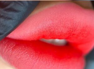 Phun môi kèm filler hoặc botox: Cần hay không?