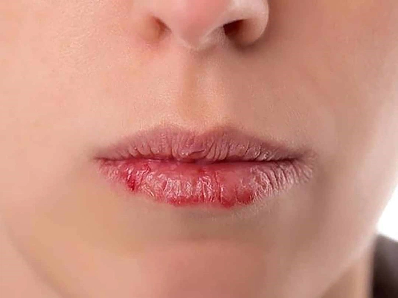 phun_moi_bi_noi_mun_trang_2_3e75a2dc7e Phun môi bị nổi mụn trắng vì cơ địa của khách hàng