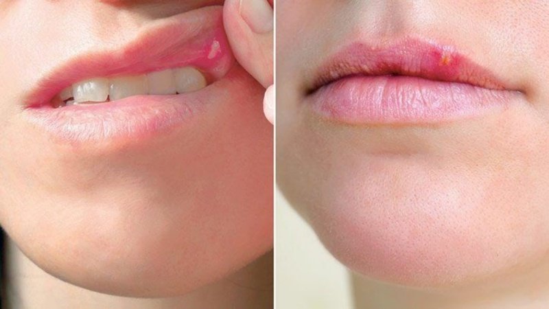 phun_moi_bi_noi_mun_trang_3_fc7565c7bf Môi bị lở loét do không kịp thời điều trị