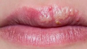 Phun môi bị nổi mụn trắng