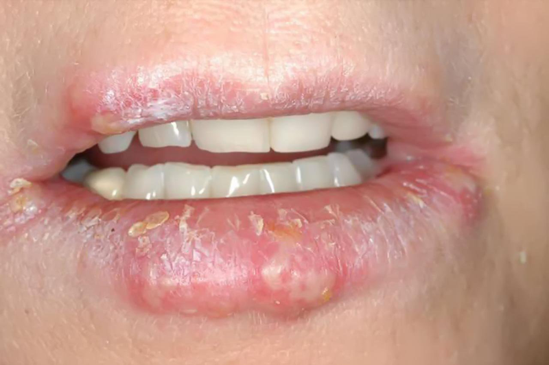 phun_moi_collagen_la_gi_tac_hai_cua_phun_moi_collagen_3378b1f325 phun-moi-collagen-la-gi-tac-hai-cua-phun-moi-collagen.jpg