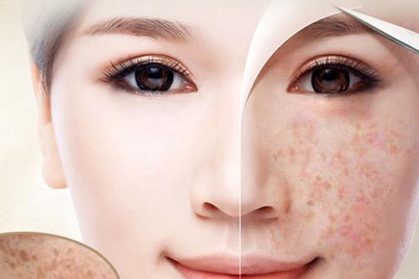 Giải pháp trị nám cấp tốc: Top 2 phương pháp hiệu quả nhất 1 Trị nám da là một trong những nhu cầu làm đẹp phổ biến nhất hiện nay