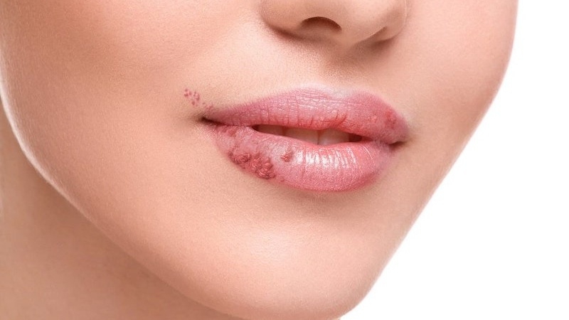 than_trong_tranh_cac_tac_dung_ngoai_y_khi_phun_moi_phu_bong_collagen_cropped_1_9e185c2a7b Thận trọng tránh các tác dụng ngoại ý khi phun môi phủ bóng collagen 2