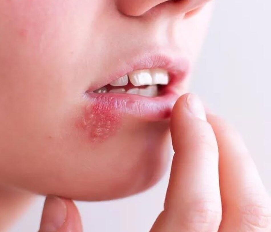 Các dấu hiệu phun môi bị hỏng 3 tim hieu nhung chan doan benh ly lien quan den moi 8475 e1756458412472