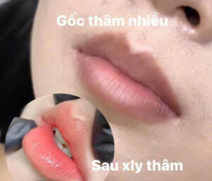 Môi từng thâm bẩm sinh thì phun môi có che được hoàn toàn không?