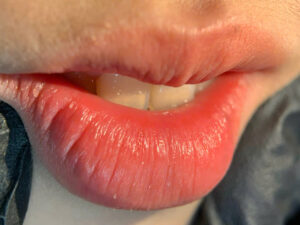 Bao lâu phun môi thì ăn uống bình thường? Sự thật bạn cần biết