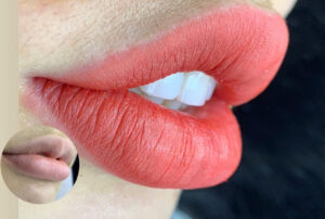 Phun môi có ảnh hưởng đến men răng không? Giải thích khoa học