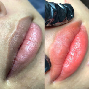 Trend phun môi 10 phút: Không đau – Không sưng