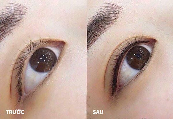Mí mở tròng là gì?