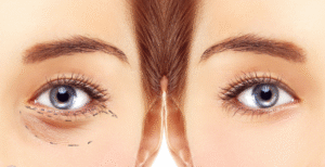 Tạo hình mi mắt