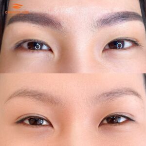 Xoá xăm chân mày