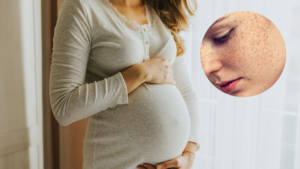 điều trị nám da khi mang thai