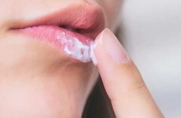 Acyclovir bôi môi có tác dụng gì? Cách bôi acyclovir sau phun môi 3 Acyclovir boi moi 3 667f7ded662ec 768x518 1 e1757953689990