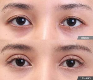 Bi sup mi co nen nhan mi khong