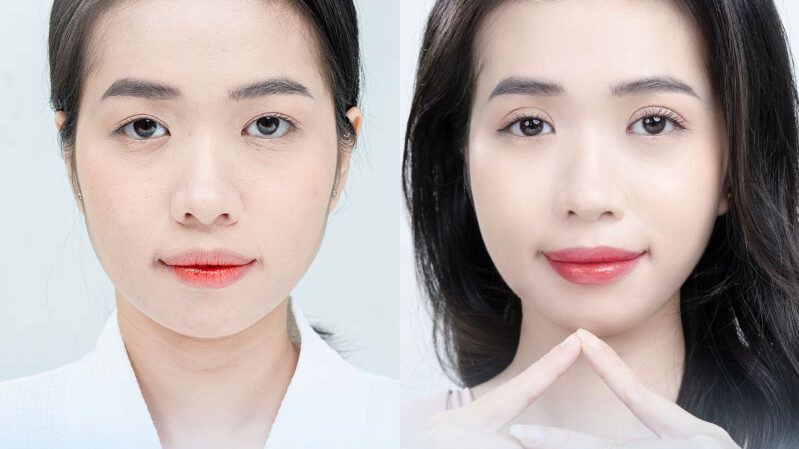 Bọng mắt đẹp hay xấu? Có nên loại bỏ hay không? 9 Bong mat dep hay xau 10 e1758881748340