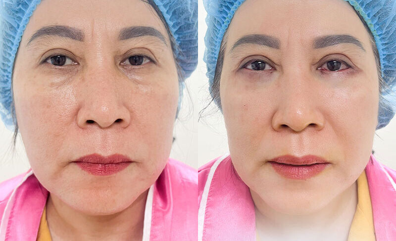 Bọng mắt đẹp hay xấu? Có nên loại bỏ hay không? 10 Bong mat dep hay xau 11 e1758881755745