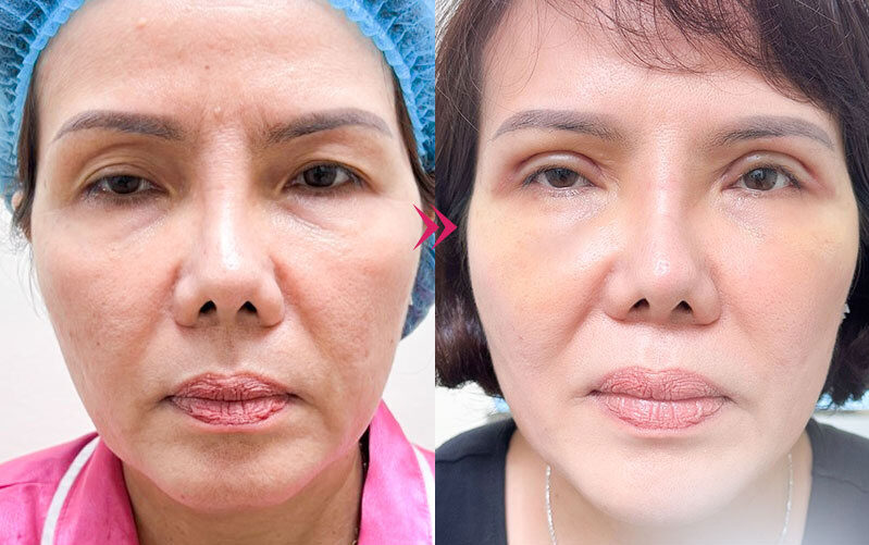 Bọng mắt đẹp hay xấu? Có nên loại bỏ hay không? 11 Bong mat dep hay xau 12 e1758881763274