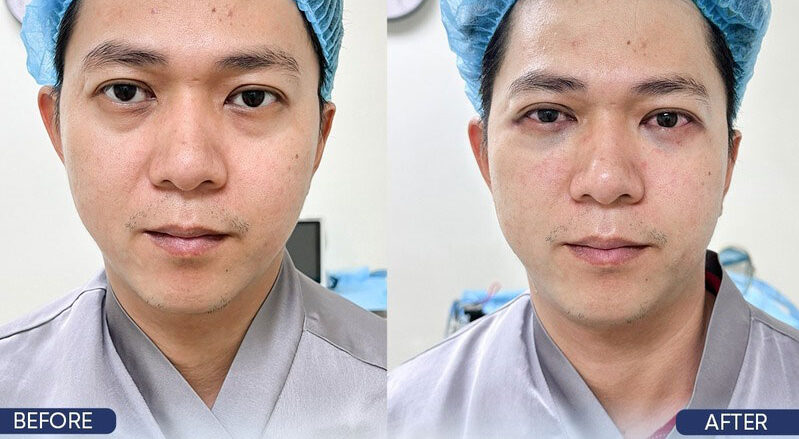 Bọng mắt đẹp hay xấu? Có nên loại bỏ hay không? 8 Bong mat dep hay xau 9 e1758881735501