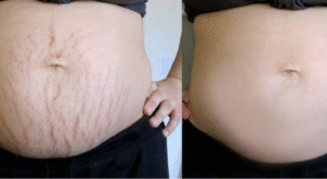 trị rạn da lâu năm