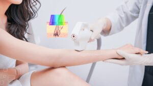 Triệt lông công nghệ IPL