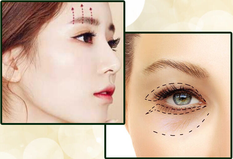Mắt sụp mí nên cắt mí hay treo chân mày? 6 NEN NANG CUNG MAY HAY CAT MI e1759200719690