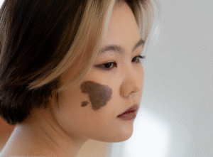 Vết bớt là gì? Chúng có gây hại đến sức khỏe hay không?