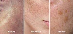 nám, tàn nhang, đồi mồi