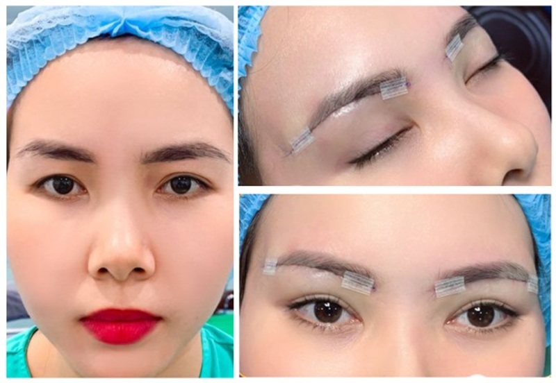 Nên cắt mí hay nâng chân mày? Đánh giá chi tiết hai phương pháp cắt mí và nâng cung mày 6 Nâng cung chân mày
