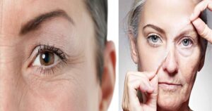 Nếp nhăn dưới mắt