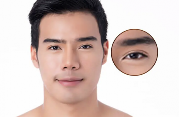Cắt mí mắt nam giới sở hữu đôi mắt tươi trẻ và đầy ấn tượng Cắt mí mắt nam giới sở hữu đôi mắt tươi trẻ và đầy ấn tượng